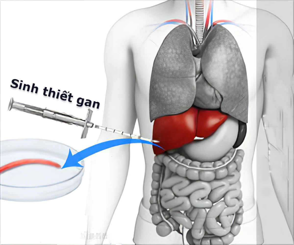 sinh-thiet-gan.webp